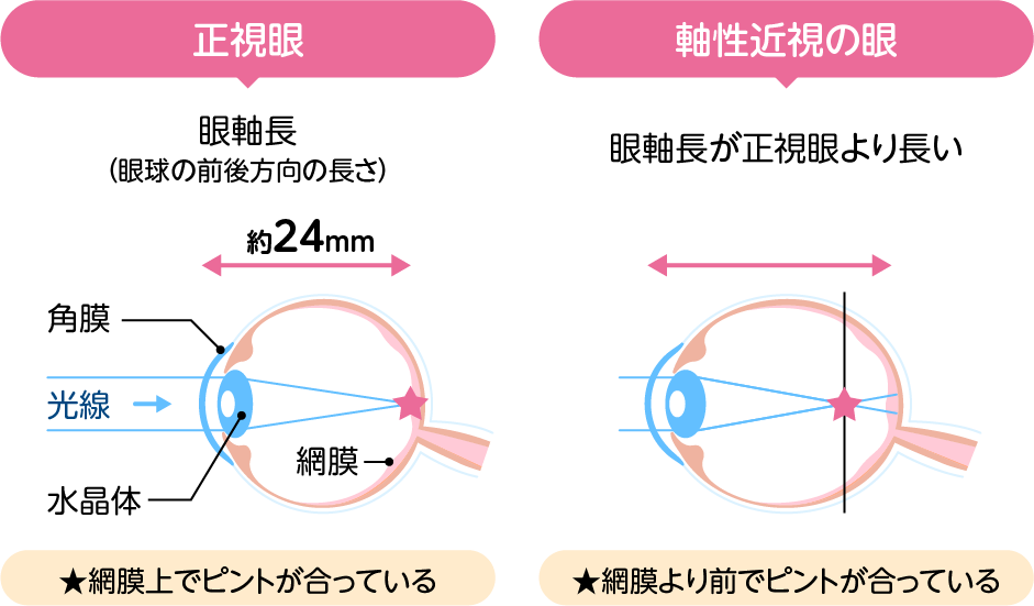 眼球の前後方向の長さ